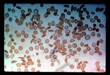 Sangeeta Bhatia's work on Measuring blood flow to monitor sickle cell disease